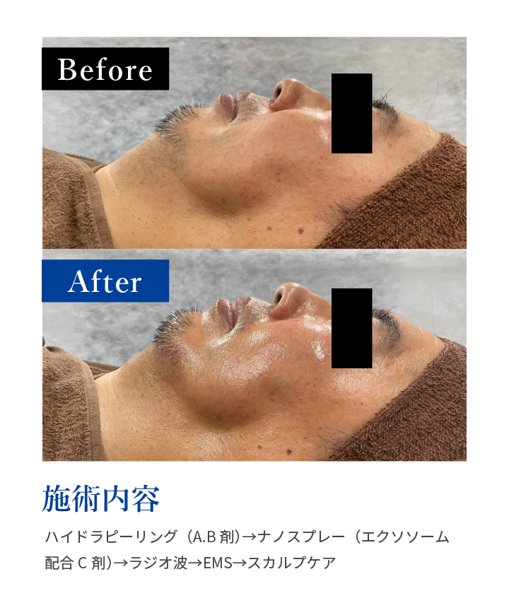 施術内容:ハイドラピーリング（A.B剤）→ナノスプレー（エクソソーム配合C剤）→ラジオ波→EMS→スカルプケア
