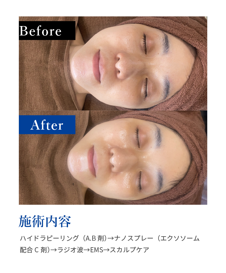 施術内容:ハイドラピーリング（A.B剤）→ナノスプレー（エクソソーム配合C剤）→ラジオ波→EMS→スカルプケア