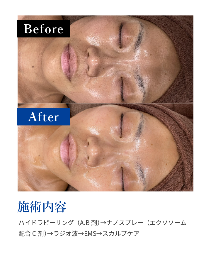 施術内容:ハイドラピーリング（A.B剤）→ナノスプレー（エクソソーム配合C剤）→ラジオ波→EMS→スカルプケア