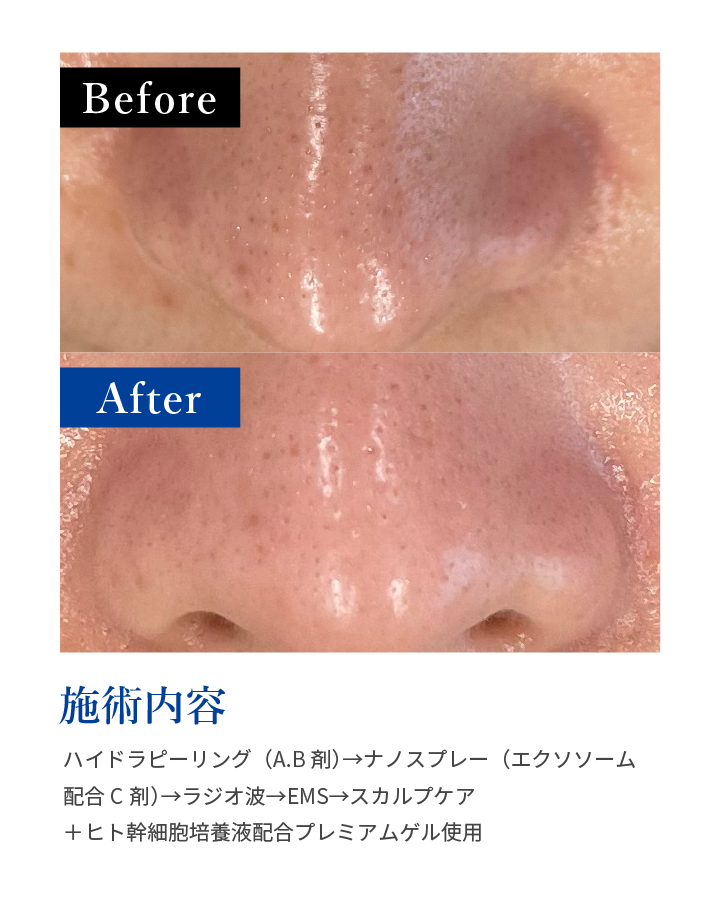 施術内容:ハイドラピーリング（A.B剤）→ナノスプレー（エクソソーム配合C剤）→ラジオ波→EMS→スカルプケア＋ヒト幹細胞培養液配合プレミアムゲル使用